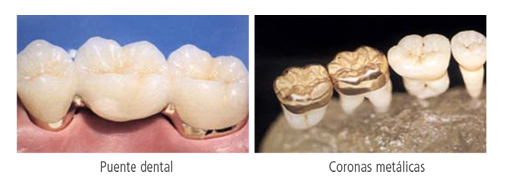 Coronas dentales o fundas: tipos y características